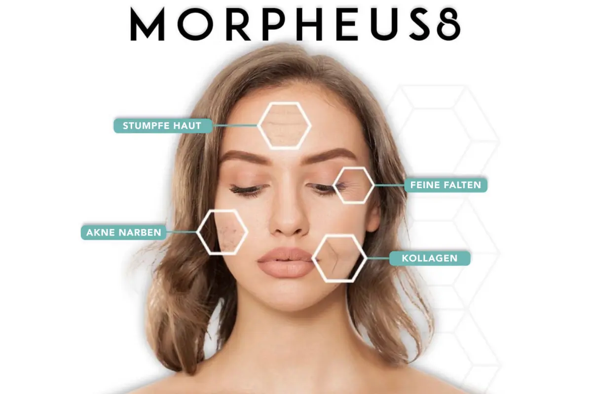 Morpheus 8